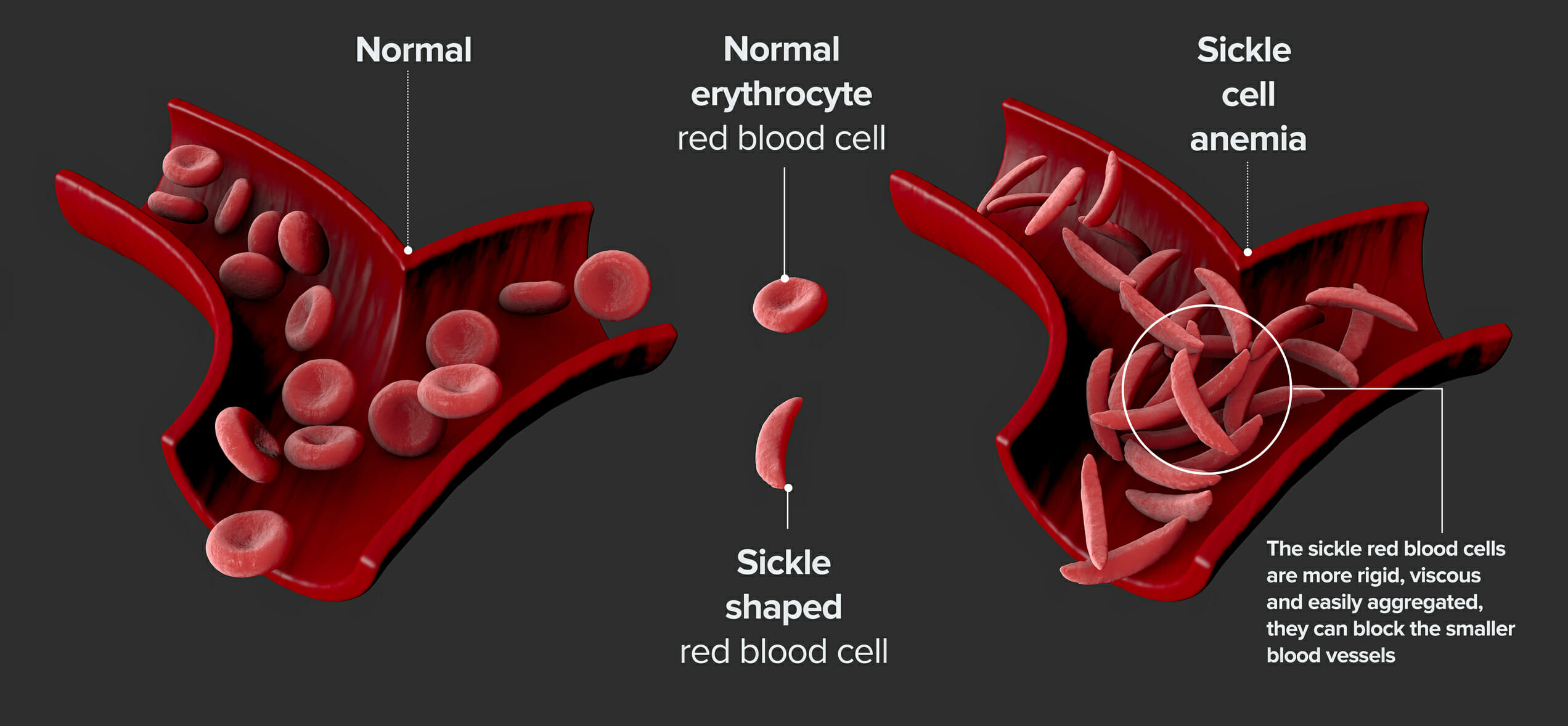 ಕುಡಗೋಲು ಕಣ ರೋಗಕ್ಕೆ (Sickle Cell Disease) ಐಸಿಎಂಆರ್ ಮೊದಲ ಸ್ಟಿಗ್ಮಾ ಮಾಪಕವನ್ನು ಬಿಡುಗಡೆ ಮಾಡಿದೆ